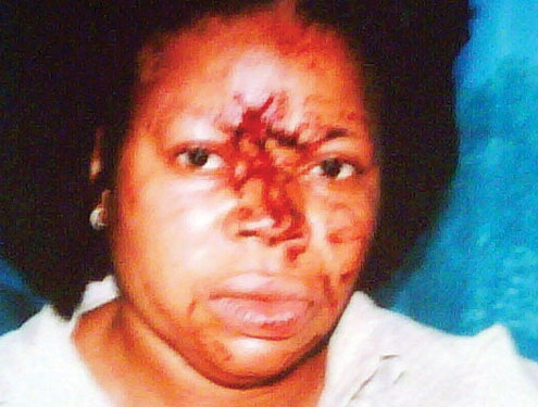 Ngozi, stabbed in the face.