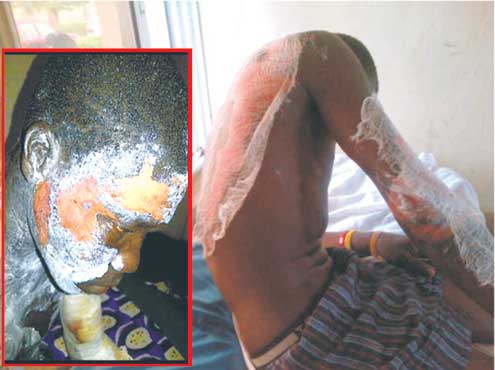 Olatunde Obasa, badly scalded by the hot water poured on him by his step-mother.