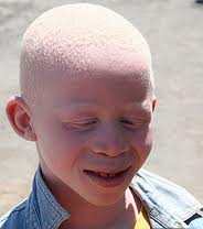 an albino boy