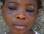 Miracle Ndubisi, still nursing the injuries inflicted on her face