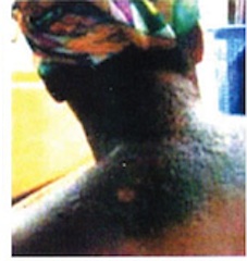 The effect of skin bleaching