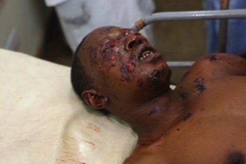 FILE PHOTO: A victim of a twin bomb blast in Gombe receiving treatment at the hospital 