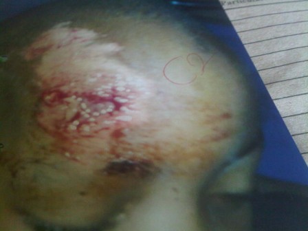 Samuel's stitched head after he was smashed on the road by the robbers