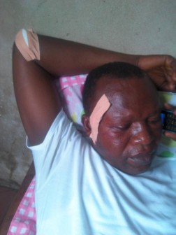 Chairman of Ekeremor Local Government Area,  Billy Tobiyei in hospital after he was attacked by suspected party thugs