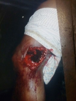 Leg of an injured man