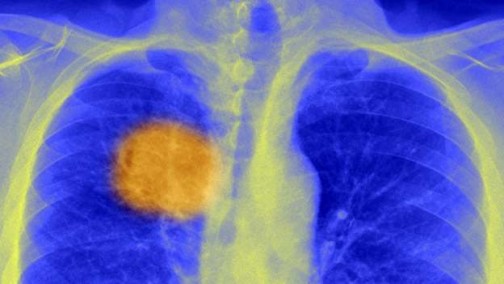 Lung cancer. Photo credit: SPL