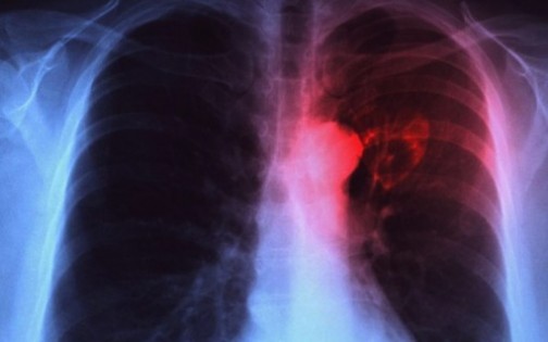 Nigeria has highest tuberculosis cases in Africa