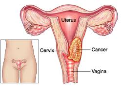 cervical-cancer
