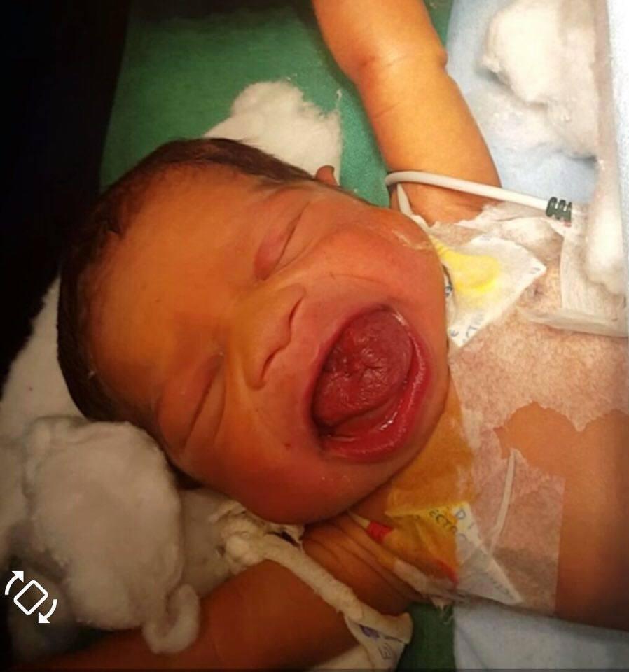 Baby born with giant tongue