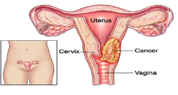 Cervical-Cancer