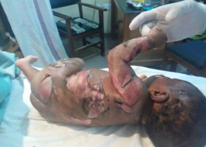 Woman-baby-suffer-severe-burns-in-kerosene-explosion