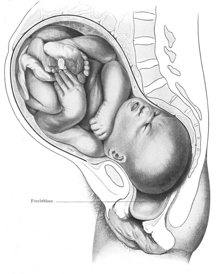 Fetus In Vagina