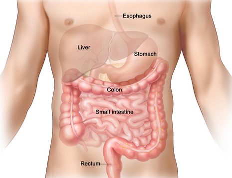 colon cancer