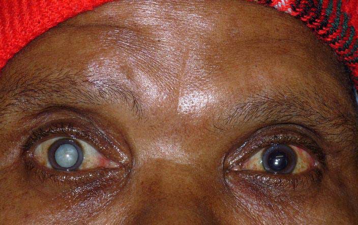 Cataract