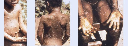 monkeypox-homepage-images-3