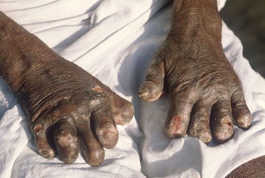 640px-Leprosy_deformities_hands