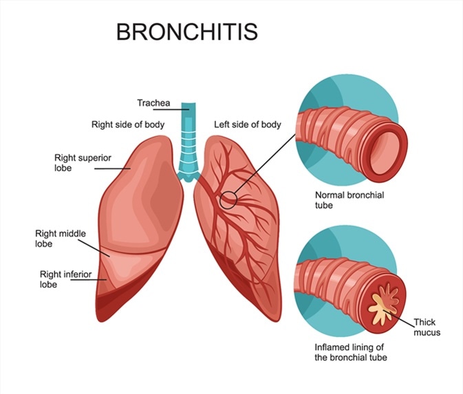 bronchitis