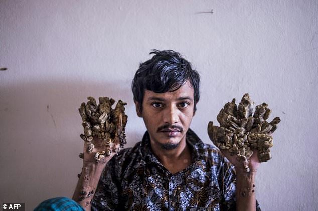 Bangladeshi man with tree hands suffering from a rare syndrome