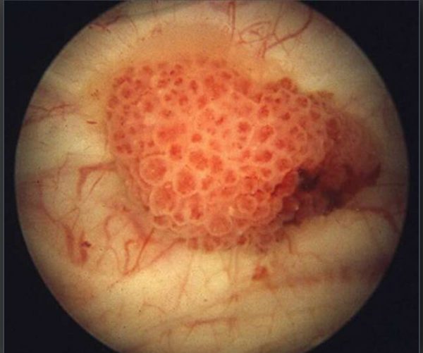 A cystoscopy image of bladder cancer cells.
