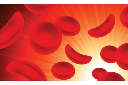Sickle cell