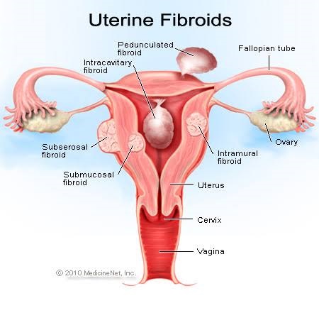 Uterine fibroids