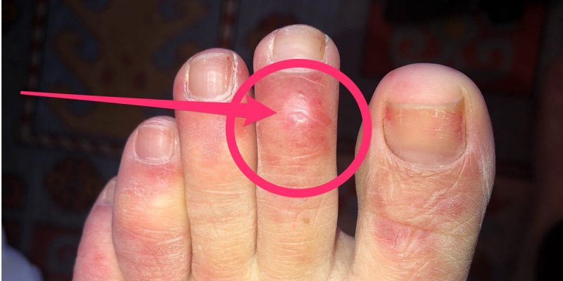 A swollen toe: sign of coronavirus