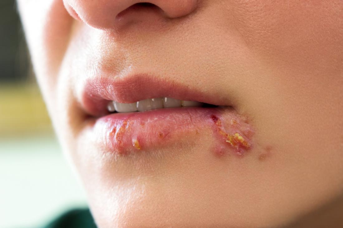 herpes-simplex-virus-with-symptoms-including-cold-sores-on-the-mouth