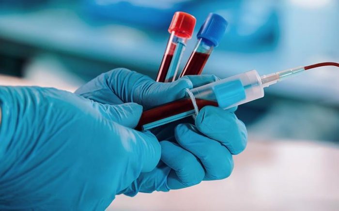 Blood sample: One ‘s blood type can determine whether one can contract coronavirus