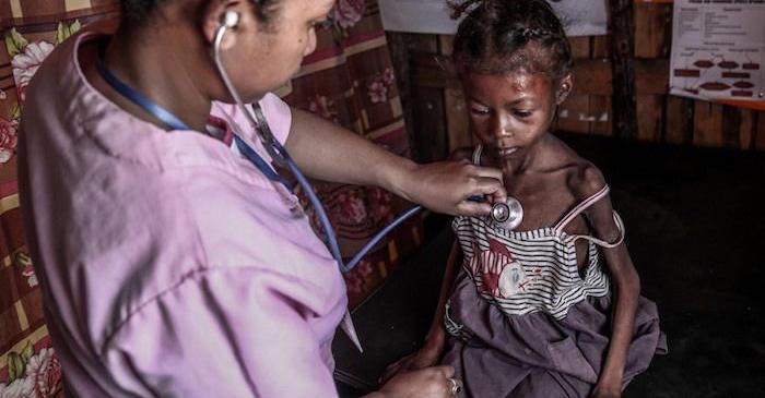 A malnourished child in southern Madagascar