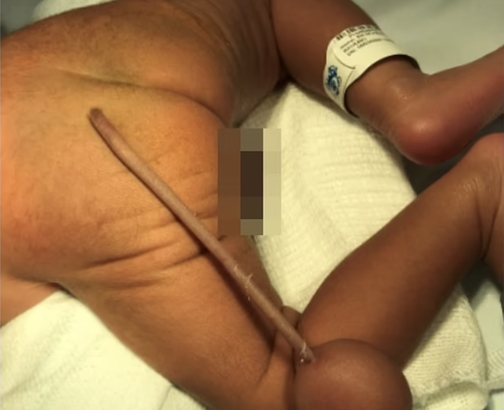 Baby born with tail