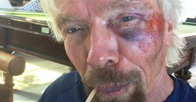 Richard Branson after the bike accident