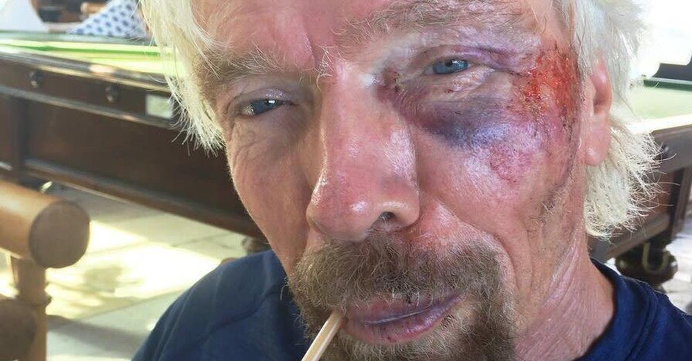 Richard Branson after the bike accident