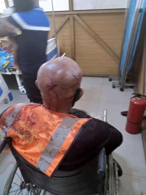 A member of Rivers  Taskforce on illegal Street Trading with the injuries he sustained during clash with angry traders and hoodlums.