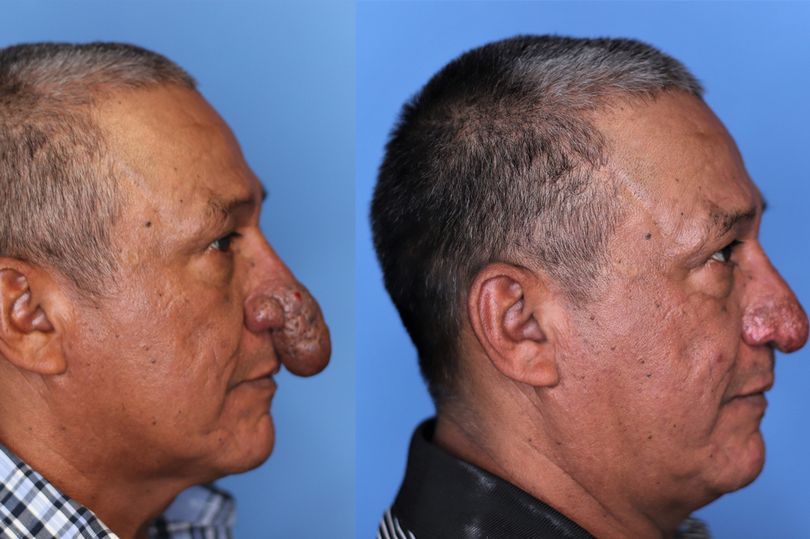 Conrado Estrada with his disfigured nose, left and after surgery