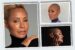 Jada Pinkett Smith and alopecia areata