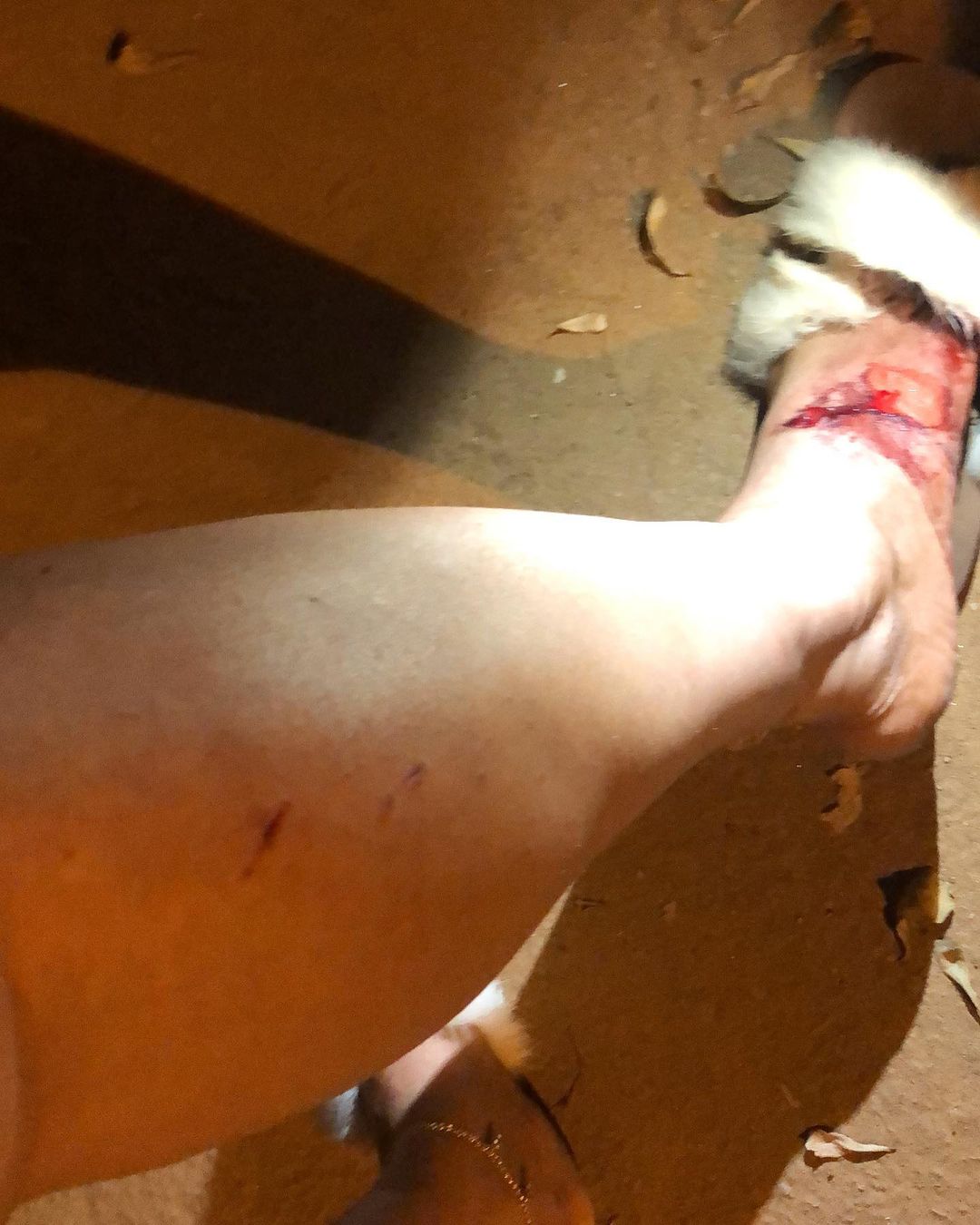 Chiwendu with a bleeding leg
