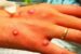 Monkeypox