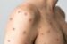 Monkeypox