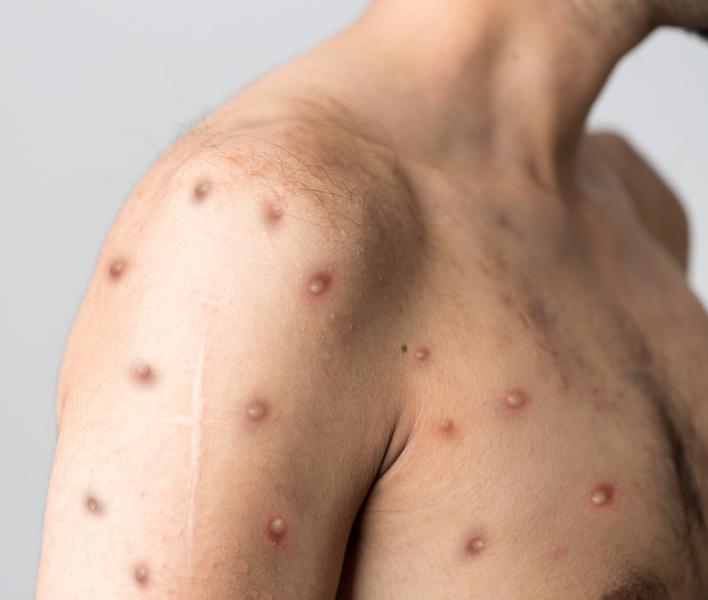 Monkeypox