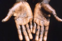 the hands of a person with monkeypox