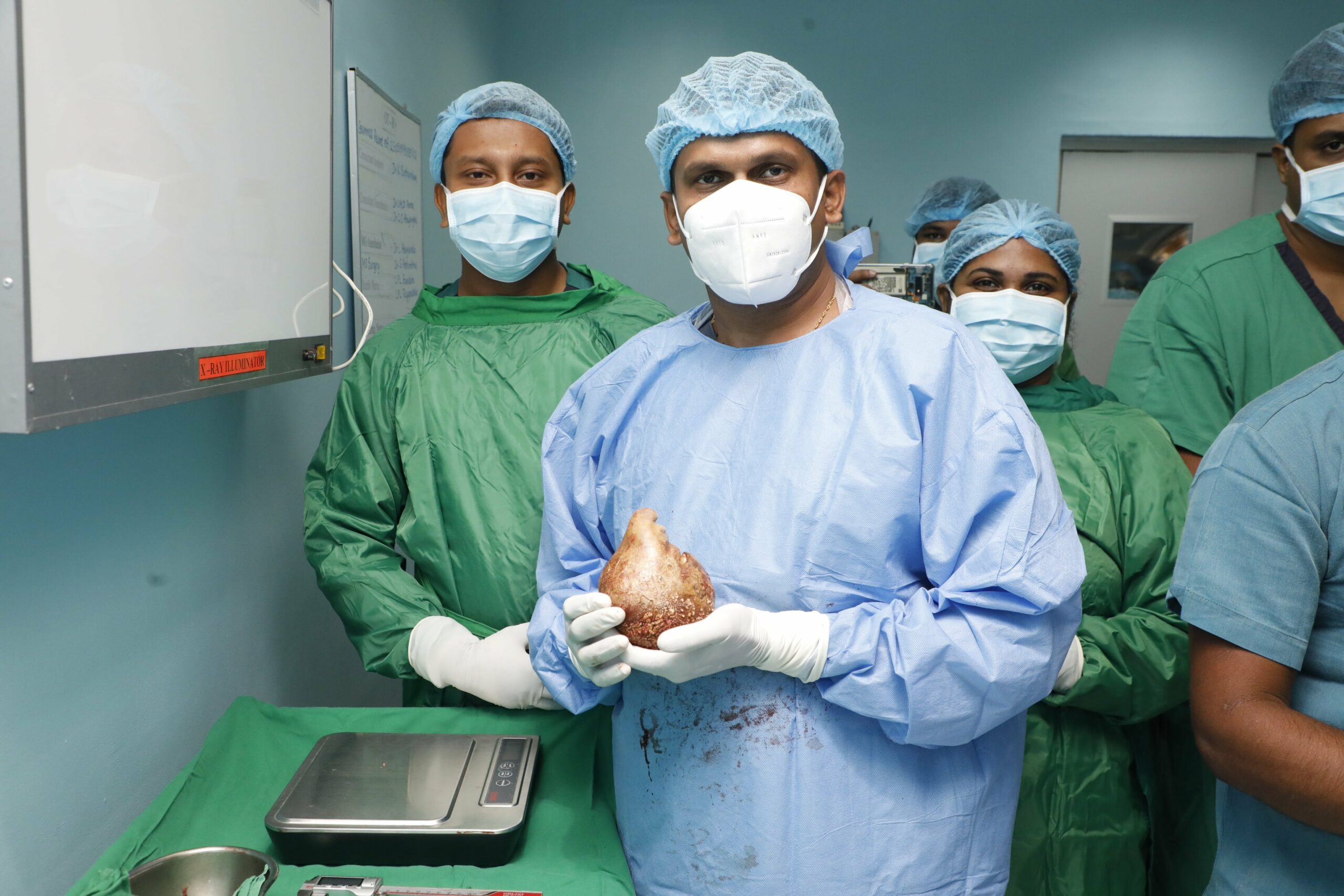 Surgeons in Sri Lanka have removed the largest AND heaviest kidney stone ever recorded.