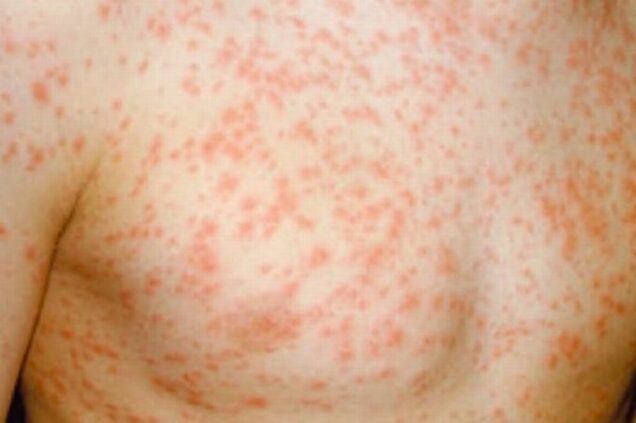 Measles infections