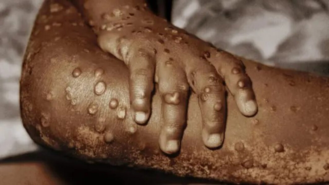 Akwa Ibom Hit By Mpox As Five Cases Confirmed Public Urged To Stay   Mpox 