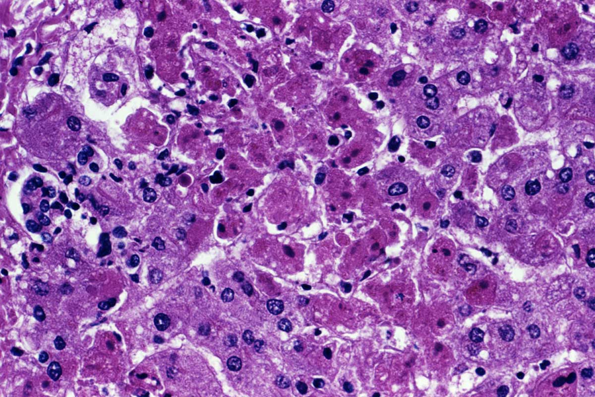 Marburg virus disease outbreak kills 6 in Rwanda