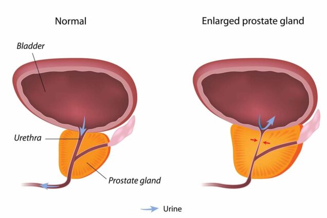 Prostate enlargement
