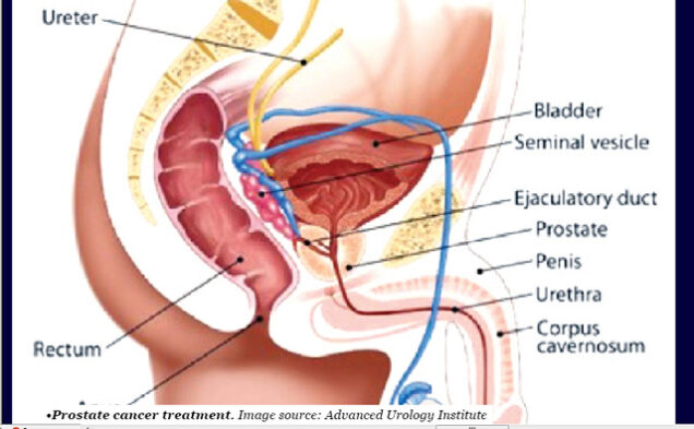 Prostate-cancer-treatment