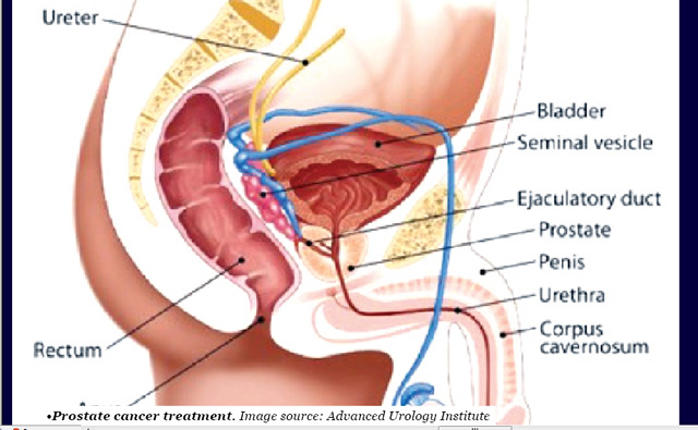 Prostate Cancer