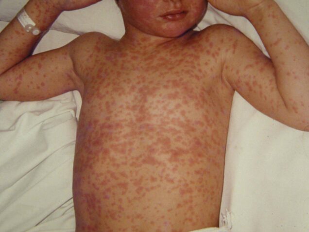 measles12-56e2fda96abd46838d59b315abf99dc3