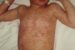 Measles