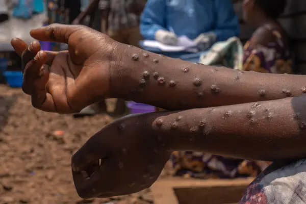 mpox